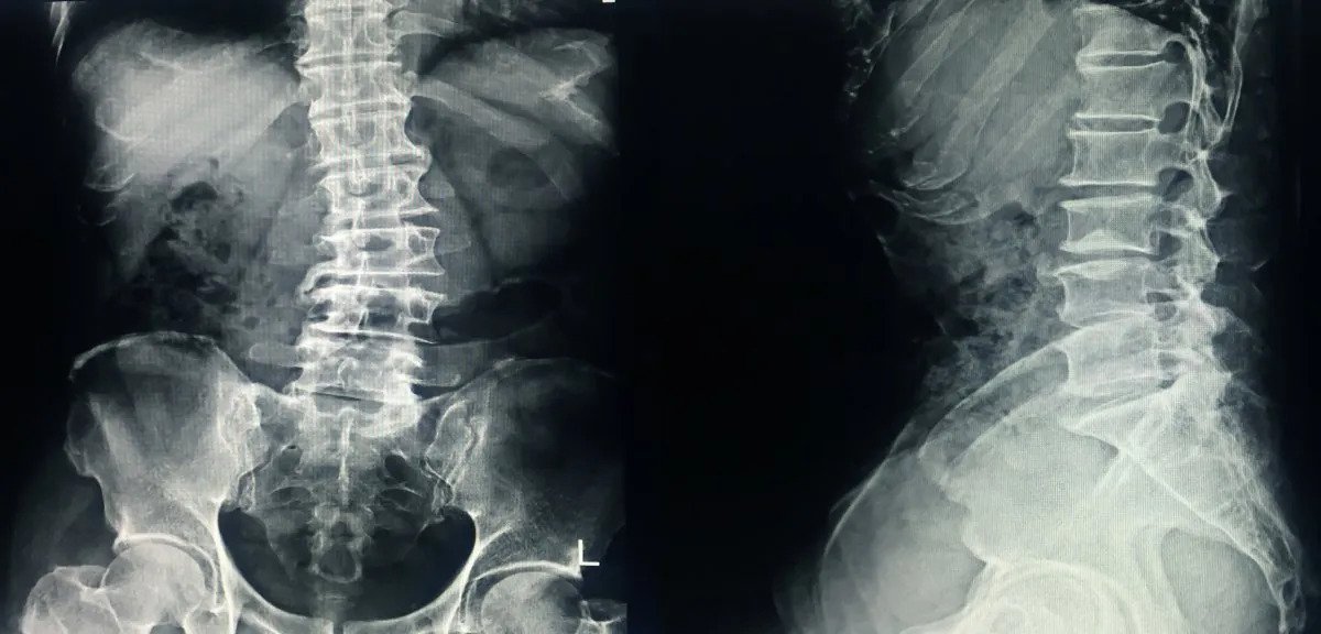 x-ray of spine with scoliosis